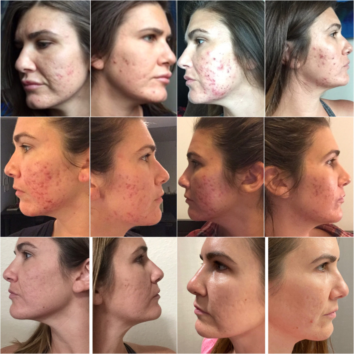 Cystic Acne Scars My Mental Health TheJJAdventures cystic-acne-scars-my-mental-health-thejjadventures
